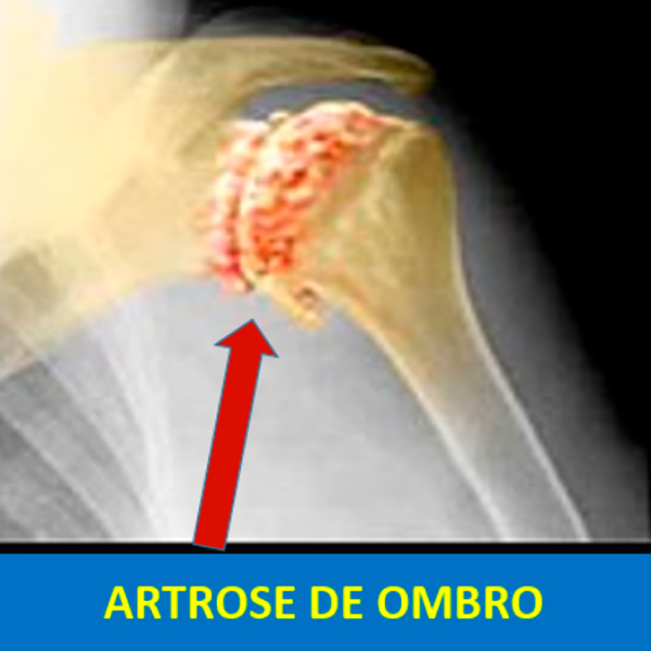 Imagem ilustrativa da notícia: Artrose do ombro